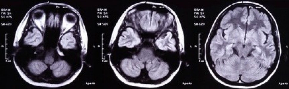 Udar mózgu – zaburzenia połykania we wczesnej fazie